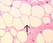 Image of adipose tissue